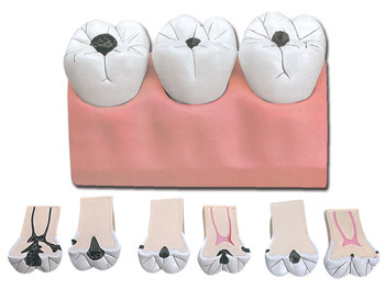 DENTÁLNY CARIES - 7 parts - 4x