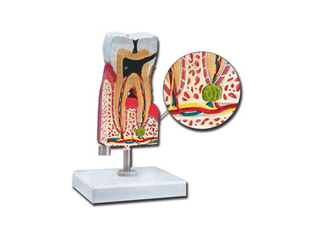 LOWER MOLAR SO CARIES - 10X