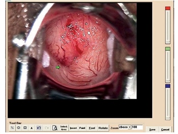 COLPOSCOPY SOFTWARE for 29620, 29622, 29600 with 29603